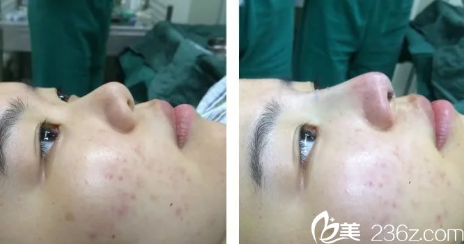 鼻綜合手術(shù)完成時<span style=