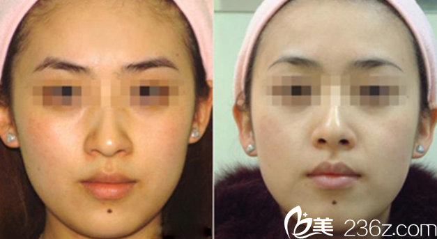 廣州星團醫(yī)美胡廣孫光子嫩膚案例