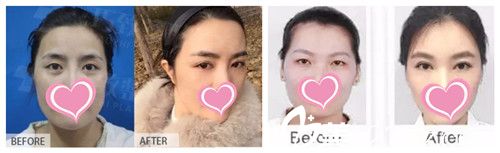 王立英院長雙眼皮案例