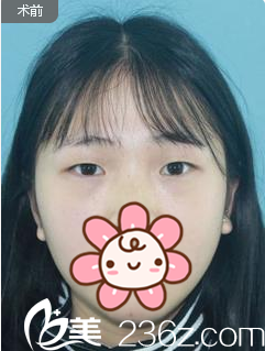 成都星美寶島全切雙眼皮+眼瞼提肌術(shù)前照 成都星美寶島全切雙眼皮+眼瞼提肌術(shù)前照