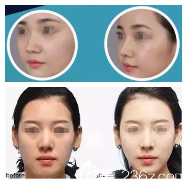 任加偉醫(yī)生線雕隆鼻案例