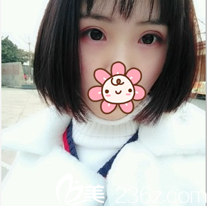 成都星美全切雙眼皮術(shù)后9個月 萌萌噠貓咪眼跟我好配哦