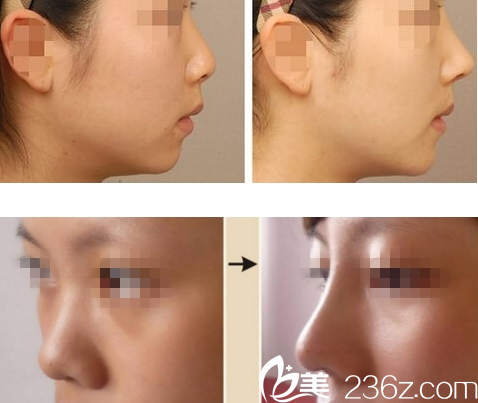 重慶賽格爾整形隆鼻<span style=