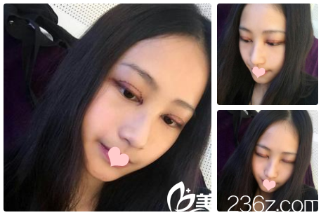 雙眼皮術(shù)后第3天恢復情況