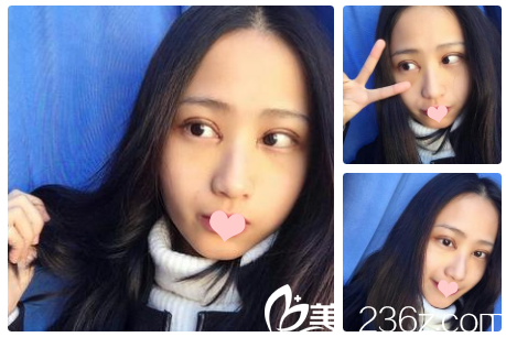 做完雙眼皮5天的樣子