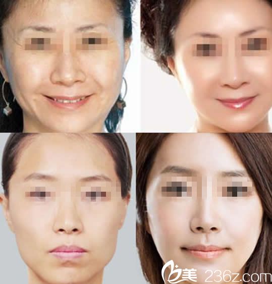 華美整形全面除皺效果 華美整形全面除皺效果