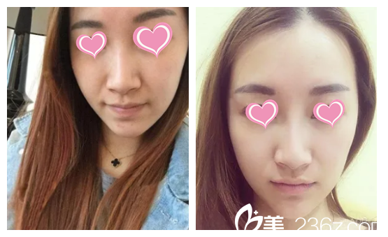 張凱華主任光子嫩膚案例