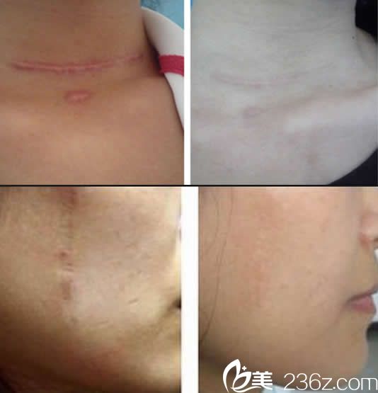 華美疤痕修復(fù)效果對比 華美疤痕修復(fù)效果對比
