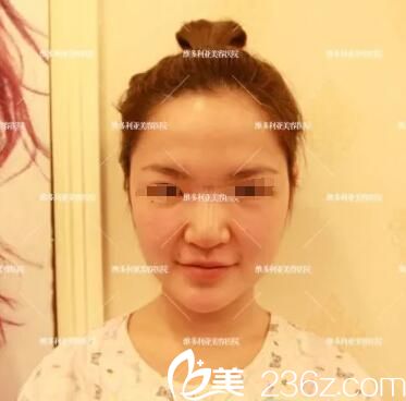 隆鼻術(shù)前塌鼻子 隆鼻術(shù)前塌鼻子