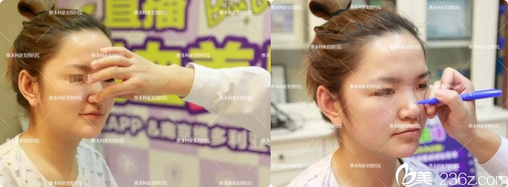 隆鼻之前的面診過程 隆鼻之前的面診過程