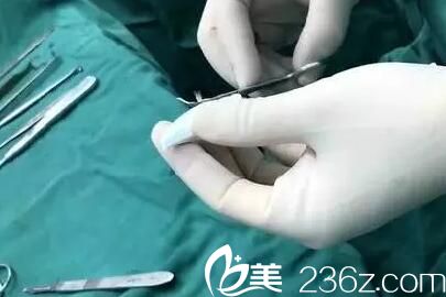 射極峰隆鼻手術(shù)過程 射極峰隆鼻手術(shù)過程