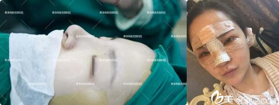 南京維多利亞隆鼻術(shù)后即刻效果 南京維多利亞隆鼻術(shù)后即刻效果