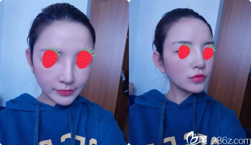 看南京維多利亞射極峰隆鼻案例剛拆完線就不腫了，你還選國產(chǎn)假體嗎