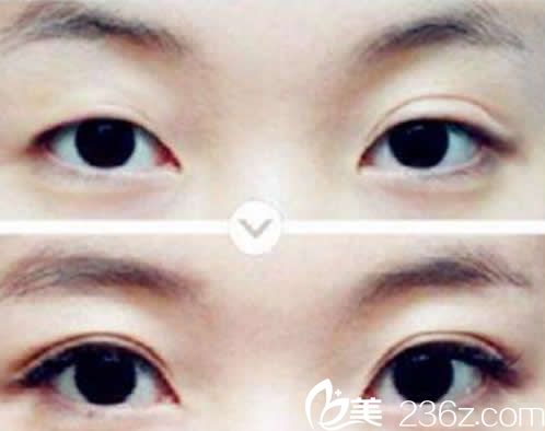 華美眼部整形效果