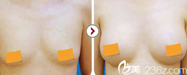 呼市華美豐胸案例