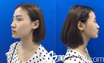 在南陽美萊做鼻綜合手術前