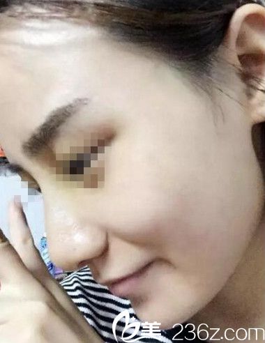 在南陽美萊做鼻綜合手術后6天