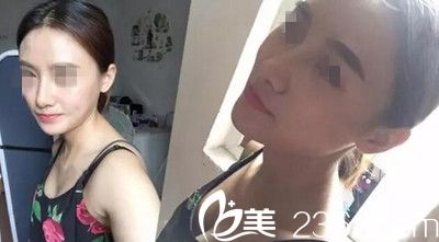 在南陽美萊做鼻綜合手術后12天
