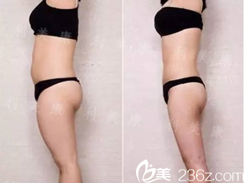 席小紅做腰腹部及大腿吸脂術(shù)后效果