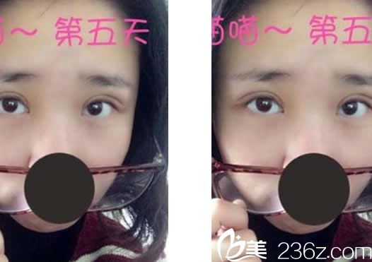 華美<!--<i data=20240703-sp></i>-->定點(diǎn)雙眼皮第五天效果