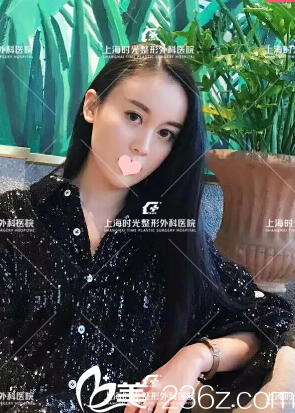 做完全臉脂肪填充一個月生活照