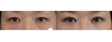 眼底脂肪再排至