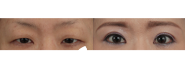 眼部案例之眼眉下拉術(shù)