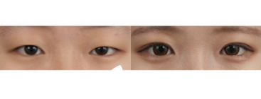 眼部手術(shù)案例之眼媚矯正