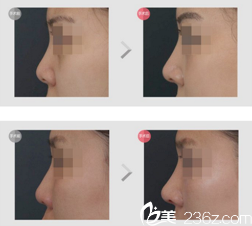 車(chē)明奎院長(zhǎng)鼻修復(fù)案例