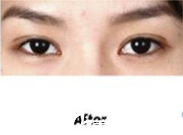 韓國(guó)麗德整形林柱煥醫(yī)生做的雙眼皮超級(jí)美，不信來(lái)看我親身經(jīng)歷