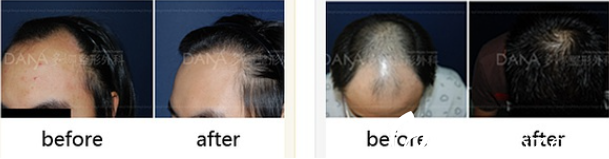樸宰賢院長毛發(fā)移植手術(shù)案例