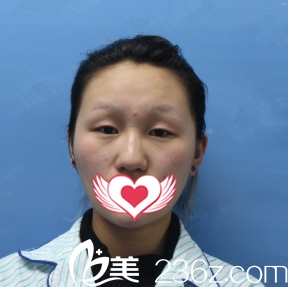 太原善美整形雙眼皮案例術(shù)前 太原善美整形雙眼皮案例術(shù)前