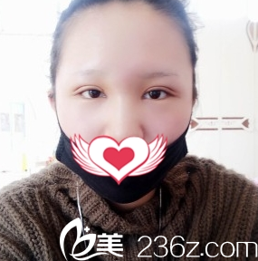 太原善美整形雙眼皮案例7天拆線 太原善美整形雙眼皮案例7天拆線