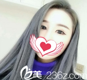 雙眼皮案例術(shù)后2個月效果太原善美整形 雙眼皮案例術(shù)后2個月效果太原善美整形