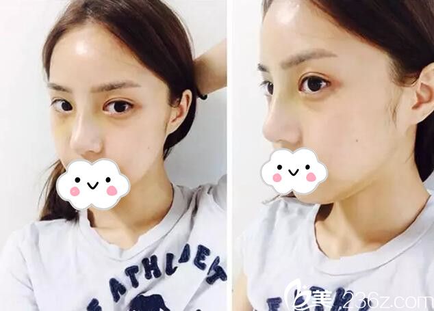 術(shù)后七天雙眼皮和隆鼻恢復(fù)過程