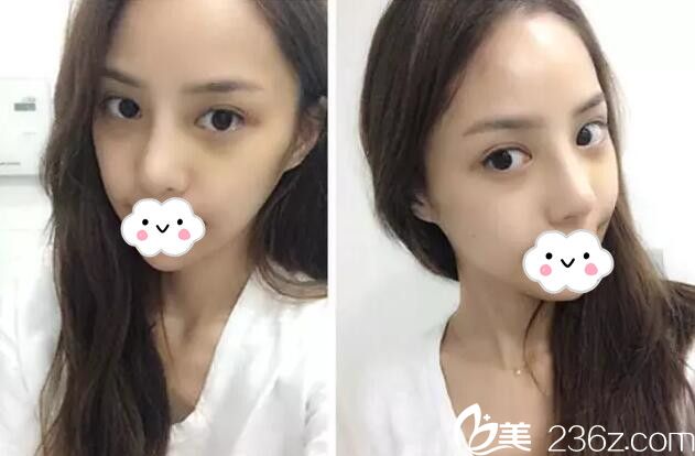 眼鼻整形術(shù)后15天恢復(fù)