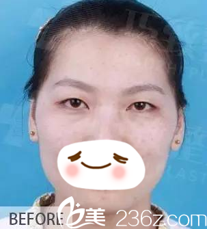 術(shù)前單眼皮無神顯眼睛小 術(shù)前單眼皮無神顯眼睛小