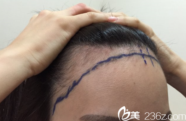 樸宰賢給我設(shè)計(jì)的新發(fā)際線