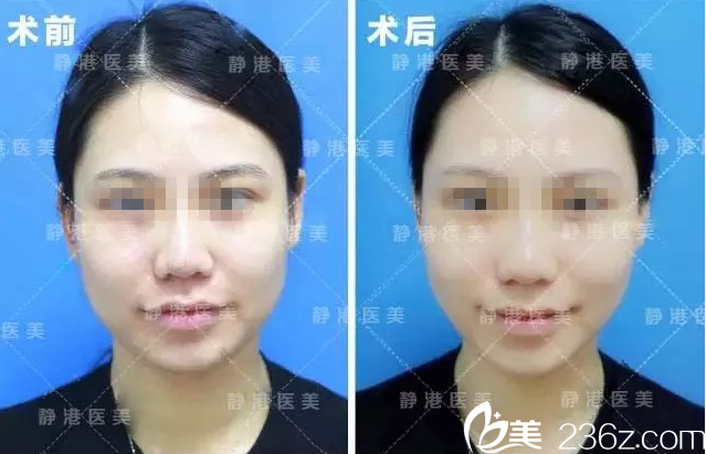 方躍明院長(zhǎng)注射瘦臉案例 方躍明院長(zhǎng)注射瘦臉案例