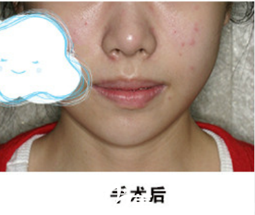 韓國延世白白汀桓院長給我做了面部輪廓，朋友贊我是完美小臉女神