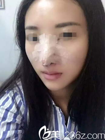 術(shù)后3天鼻子腫脹厲害