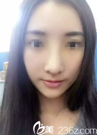 鼻綜合整形后7天鼻子拆線后的樣子