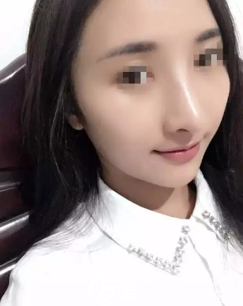 術(shù)后15天鼻子恢復(fù)情況