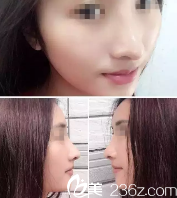 思來(lái)想去還是到滄州靜港找季澤東做了達(dá)拉斯綜合隆鼻 沒(méi)想到效果如此驚人