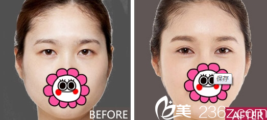 重慶新銅雀臺整形雙眼皮實例