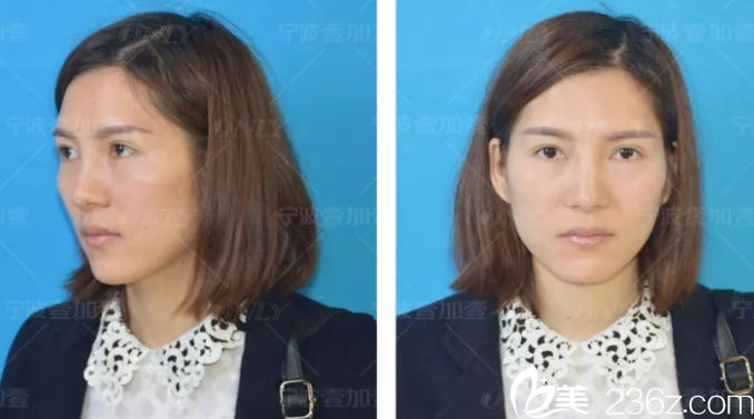 做自體脂肪填充前的側面照片