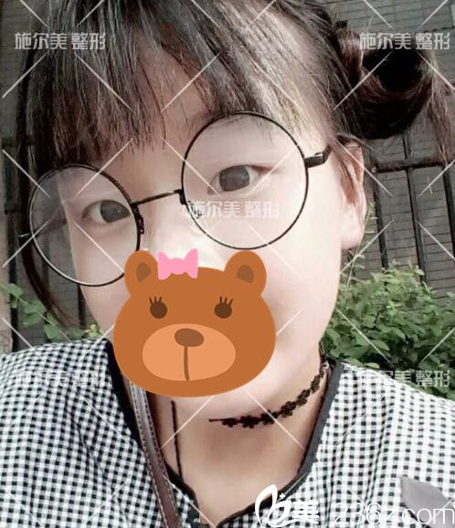 去常州施爾美做芭比眼綜合術(shù)前 去常州施爾美做芭比眼綜合術(shù)前