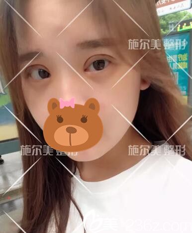 術(shù)后第十天眼部恢復(fù) 術(shù)后第十天眼部恢復(fù)