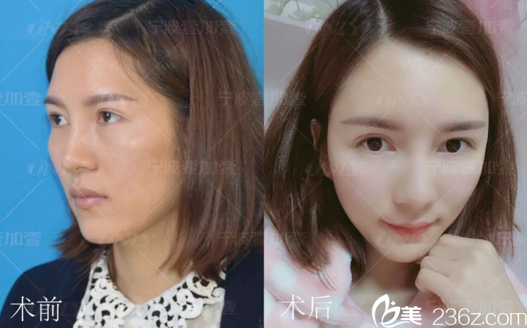 自體脂肪填充手術15天<span style=