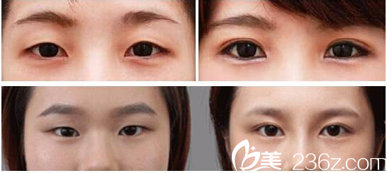 傘光院長(zhǎng)雙眼皮案例